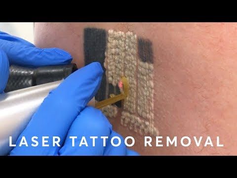 Laser Tattoo Removal: PAIN, RESULTS & PROCEDURE