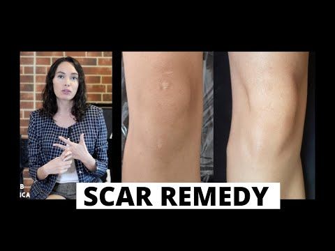 WHAT KINDS OF SCARS CAN BE CAMOUFLAGED? Scar Camouflage tattoo explained. (Paramedical Tattoo)