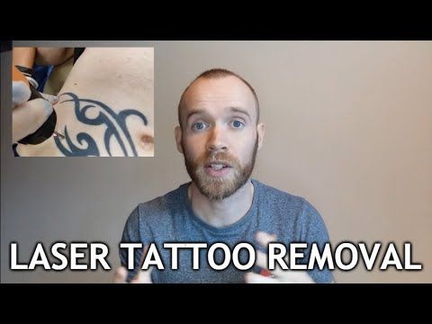Laser Tattoo Removal  - Sessions 1-3 Update
