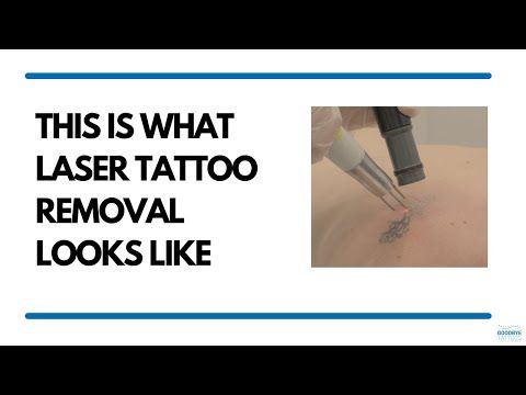 This Is What Laser Tattoo Removal Looks Like