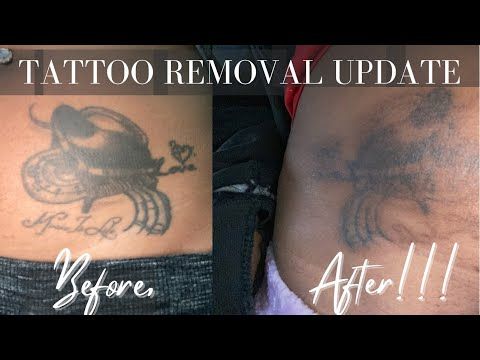 Tattoo Removal Update| Cost, PAIN, Full Details|Laser Tattoo Removal| Before & After| Sessions 1-4